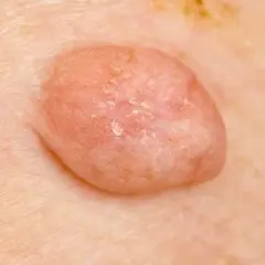 HPV: Dermatolog czy urolog? Który specjalista pomoże w infekcji?