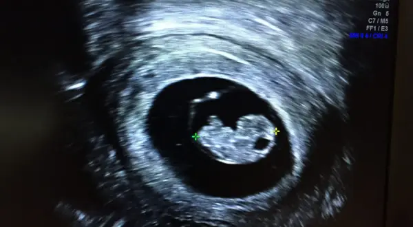 Pierwsze chwile radości, kiedy USG wykryje ciążę. Widać zarodek o długości 1.83 cm, mający 8 tygodni i 2 dni.