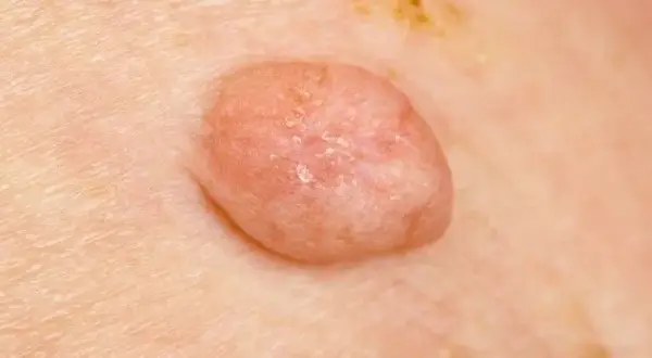 HPV: Dermatolog czy urolog? Który specjalista pomoże w infekcji?